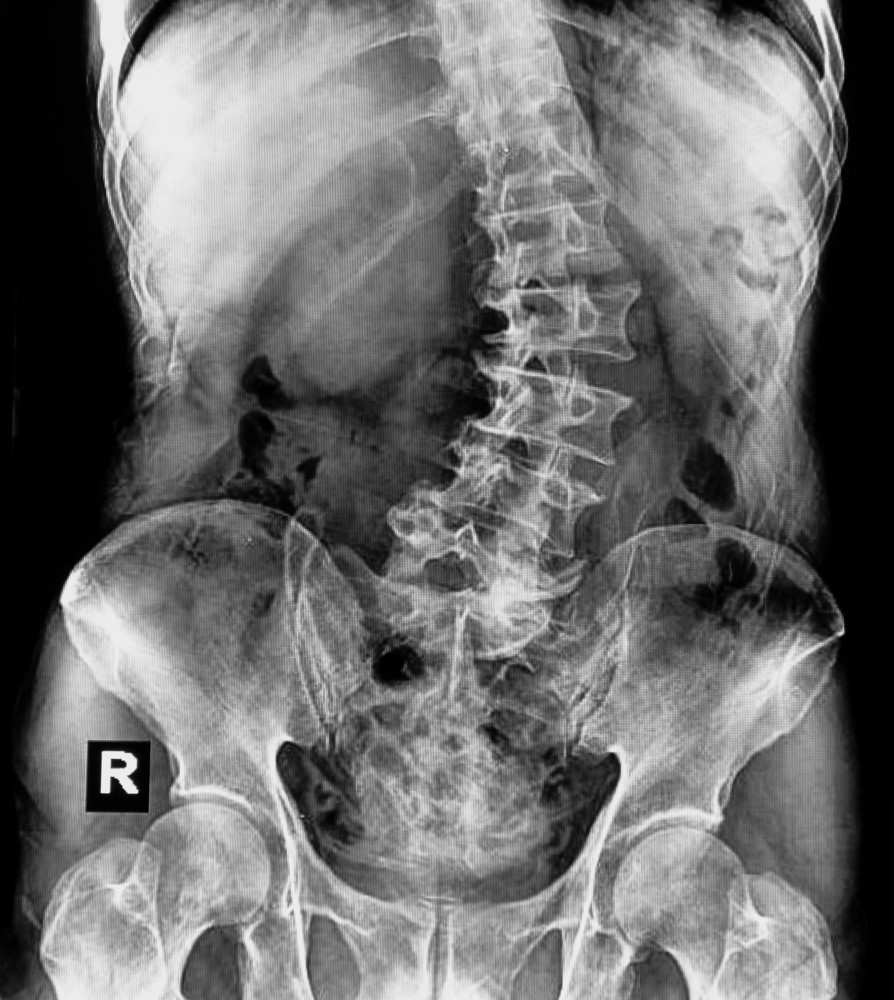 lumbar scoliosis